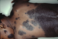 Congenital melanocytic nevus